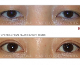 Ptosis correction