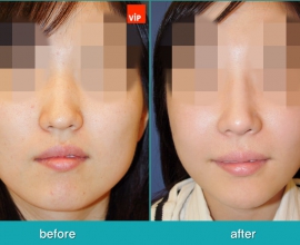 Septorhinoplasty, Face Contouring Surgery, Jawline Reduction, Cheekbon…