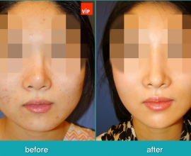 Face Contouring Surgery, V-line Jaw Reduction, Harmony Rhinoplasty usi…