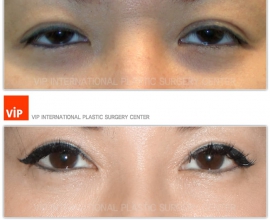 Double Fold, Ptosis Correction, Epicanthoplasty