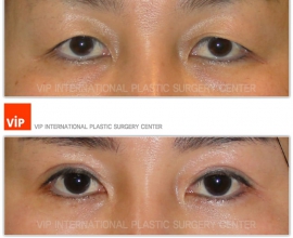 Ptosis Correction