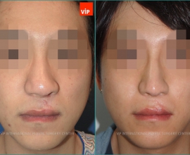 cleft lip nose surgery