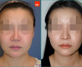 Rib cartilage rhinoplasty, Mid face augmentation