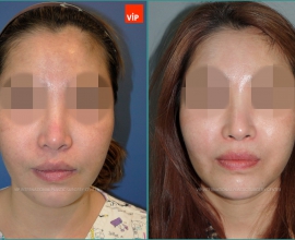 Rib cartilage rhinoplasty