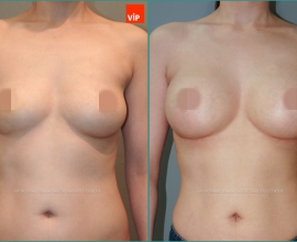 Breast Surgery