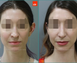 Septal cartilage rhinoplasty, Septal Deviation