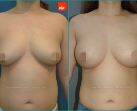 Breast Surgery