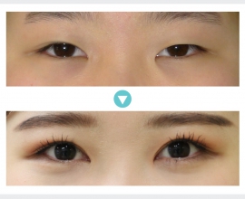 Ptosis Correction