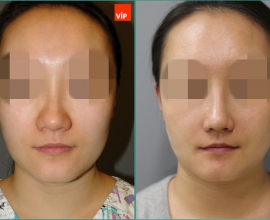 Septal cartilage rhinoplasty