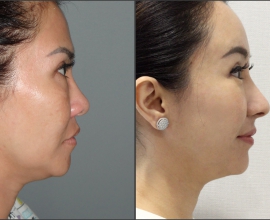 Rib cartilage Rhinoplasty, Endoscopic Forehead Lift, Fat graft, Latera…