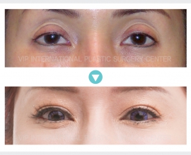 Ptosis Correction, Upper Eyelid Fat graft