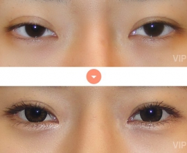 Double Eyelid Surgery