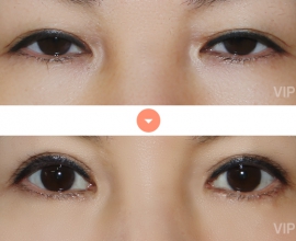 Double eyelid surgery