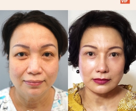 Deep Plane Facelift, Neck lift, & Rib Cartilage Rhinoplasty