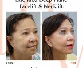 Extended Deep Plane Facelift & Necklift