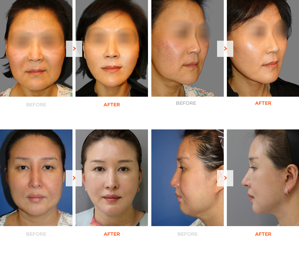 Mini Facelift before and after