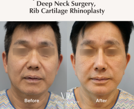 Deep Plane Facelift, Necklift, Deep Neck Surgery, Rib Cartilage Rhinoplasty, Genioplasty