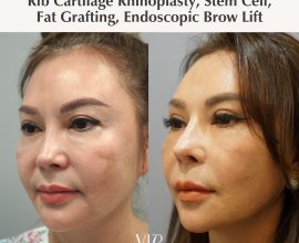 Deep plane facelift, Necklift, Rhinoplasty, Brow lift, Fat graft, Stem cell